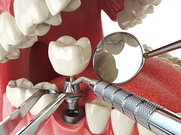 Best Emergency Root Canal Treatment in Riesel, TX